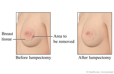 Before and after lumpectomy