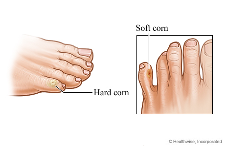 Hard and soft corns on toes.