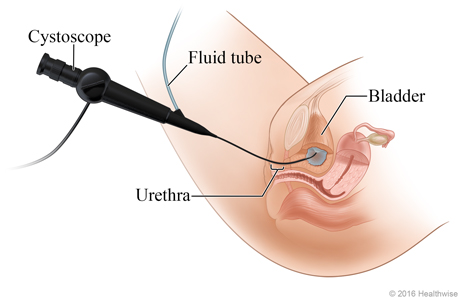 Picture of cystoscopy of the bladder.