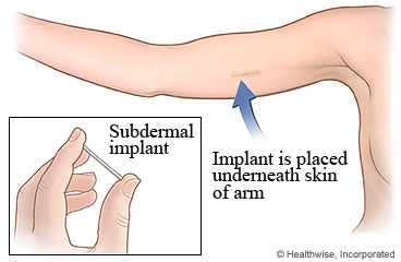 Subdermal implant under the skin