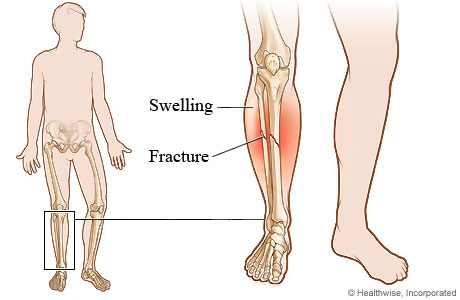 Picture of a lower leg fracture