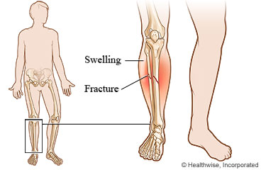 Lower leg fracture
