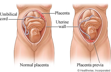 Normal placenta and lacenta previa