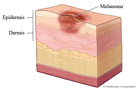 Cross section of layers of skin, with a spot of melanoma through epidermis and into dermis below it.