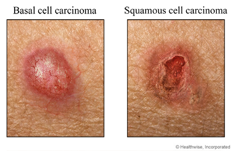 Examples of basal cell carcinoma and squamous cell carcinoma.