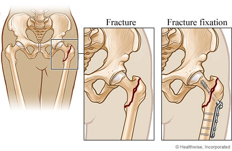 Hip repair for a hip fracture