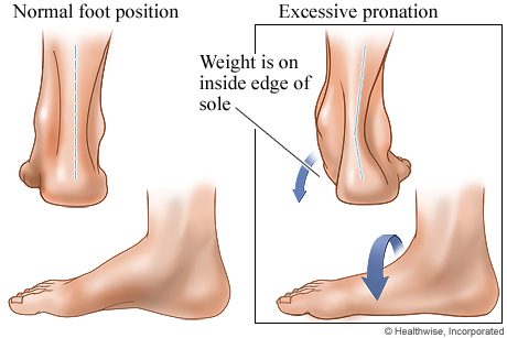 Normal foot position and excessive pronation