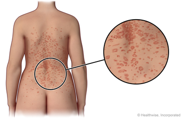 Pityriasis rosea on the back, with close-up of the rash