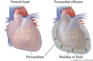 Normal heart and heart with pericardial effusion