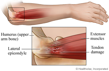 Tennis elbow anatomy: side view