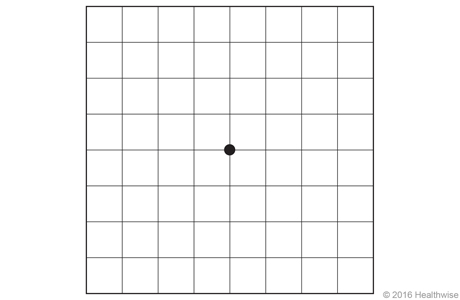 Normal Amsler grid