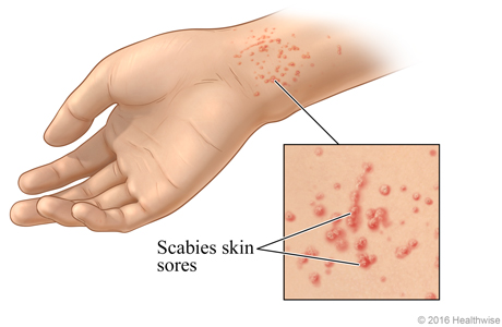 Scabies rash on a wrist, with close-up of typical sores.