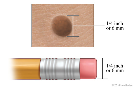 A mole, showing its width compared to a pencil eraser