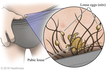 Pubic lice near pubic area, with close-up of louse and eggs (nits)