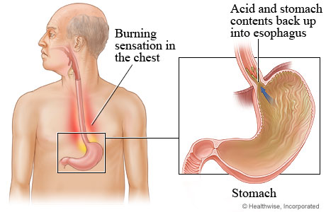 Location of stomach, with detail of acid backing up into esophagus