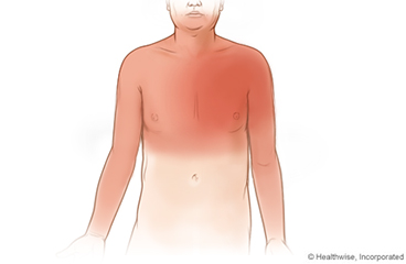 Possible zones of pain felt with angina