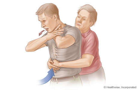 Choking rescue procedure (Heimlich maneuver) with an adult.