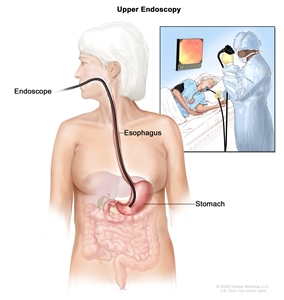 Upper endoscopy; shows endoscope inserted through the mouth and esophagus and into the stomach. Inset shows patient on table having an upper endoscopy.