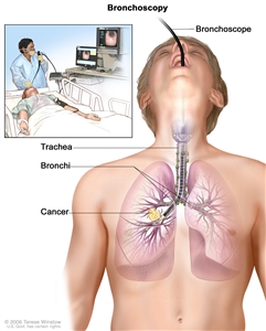 Bronchoscopy; drawing shows a bronchoscope inserted through the mouth, trachea, and bronchus into the lung; lymph nodes along trachea and bronchi; and cancer in one lung. Inset shows patient lying on a table having a bronchoscopy.