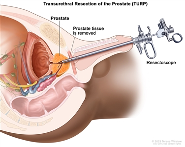 Transurethral resection of the prostate; drawing shows removal of tissue from the prostate using a resectoscope (a thin, lighted tube with a cutting tool at the end) inserted through the urethra.