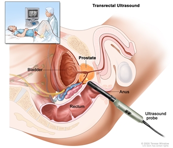 Transrectal ultrasound; drawing shows a side view of the male reproductive and urinary anatomy including the prostate, anus, rectum, and bladder; also shows an ultrasound probe inserted into the rectum to check the prostate. Inset shows patient lying on back on a table having a transrectal ultrasound procedure.