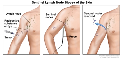 Sentinel lymph node biopsy of the skin. The first of three panels shows a radioactive substance and/or blue dye injected near the tumor; the middle panel shows that the injected material is followed visually and/or with a probe that detects radioactivity to find the sentinel nodes (the first lymph nodes to take up the material); the third panel shows the removal of the tumor and the sentinel nodes to check for cancer cells.