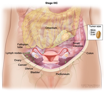 Drawing of stage IIIC shows cancer inside both ovaries that has spread to the omentum. The cancer in the omentum is larger than 2 centimeters. An inset shows 2 centimeters is about the size of a peanut. Also shown are the small intestine, colon, fallopian tubes, uterus, bladder, and lymph nodes behind the peritoneum.