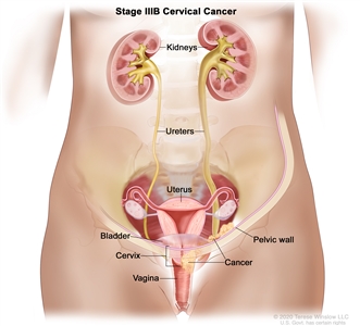 Stage IIIB cervical cancer; drawing shows cancer in the cervix and pelvic wall. Also shown is cancer blocking the right ureter and an enlarged right ureter and right kidney. The uterus, bladder, and vagina are also shown.