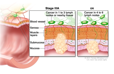 Stage IIIA colorectal cancer; drawing shows a cross-section of the colon/rectum and a two-panel inset. Each panel shows the layers of the colon/rectum wall: the mucosa, submucosa, muscle layers, and serosa. Also shown are a blood vessel and lymph nodes. The first panel shows cancer in the mucosa, submucosa, and muscle layers and in 2 lymph nodes. The second panel shows cancer in the mucosa and submucosa and in 5 lymph nodes.