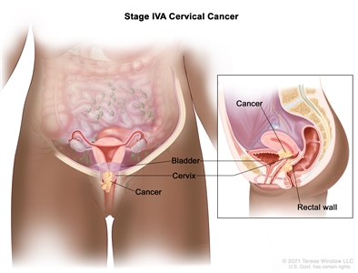 Stage IVA cervical cancer; drawing and inset show cancer that has spread from the cervix to the bladder and rectal wall.