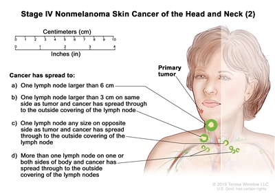 Stage IV nonmelanoma skin cancer of the head and neck (2); drawing shows a primary tumor on the face and cancer that has spread to: (a) one lymph node that is larger than 6 centimeters; (b) one lymph node on the same side of the body as the tumor, the node is larger than 3 centimeters, and cancer has spread through to the outside covering of the lymph node; (c) one lymph node on the opposite side of the body as the tumor, the node is any size, and cancer has spread through to the outside covering of the lymph node; and (d) more than one lymph node on one or both sides of the body and cancer has spread through to the outside covering of the lymph nodes. Also shown is a 10-centimeter ruler and a 4-inch ruler.