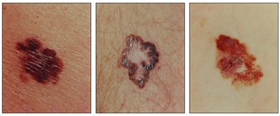Photographs showing a large, asymmetrical, red and brown lesion on the skin (panel 1); a brown lesion with a large and irregular border on the skin (panel 2); and a large, asymmetrical, scaly, red and brown lesion on the skin (panel 3).