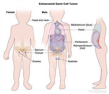 Extracranial germ cell tumor; drawing shows parts of the body where extracranial germ cell tumors may form, including the head and neck, mediastinum (the area between the lungs, shown in blue), retroperitoneum (the area behind the abdominal organs, shown in red), sacrum, coccyx, testicles (in males), and ovaries (in females). Also shown are the heart and peritoneum.
