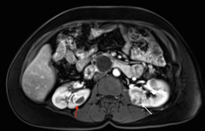 Axial view of an individual's midsection showing tumors in both kidneys. The left kidney has a tumor with a dark cystic component and the right kidney has a predominantly solid tumor.