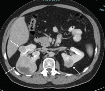 Axial view of an individual's midsection showing two tumors in the left kidney and one tumor in the right kidney.