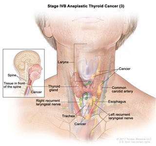 Stage IVB anaplastic thyroid cancer (3); drawing shows cancer in the thyroid gland and in the esophagus, the trachea, the larynx, the left recurrent laryngeal nerve, and the tissue in front of the spine (inset). Cancer has also surrounded the common carotid artery and the blood vessels in the area between the lungs. Also shown is the right recurrent laryngeal nerve.