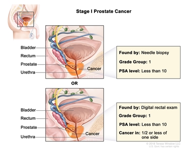 Two panel drawing of stage I prostate cancer; the top panel shows cancer in less than one-half of the right side of the prostate found by needle biopsy. The bottom panel shows cancer in less than one-half of the left side of the prostate found by digital rectal exam. In both panels, the PSA level is less than 10 and the Grade Group is 1. The bladder, rectum, and urethra are also shown.