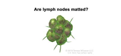 Melanoma staging (matted lymph nodes); drawing shows matted lymph nodes with cancer.