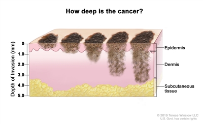 Melanoma staging (tumor thickness); drawing shows different depths of cancer invasion (0, 1.0, 2.0, 3.0, 4.0, and 5.0 mm) into the epidermis (outer layer of the skin), the dermis (inner layer of the skin), and the subcutaneous tissue below the dermis.