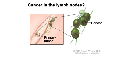 Melanoma staging (lymph node involvement); drawing shows cancer that has spread from the primary tumor to the lymph nodes.
