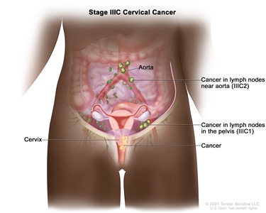 Stage IIIC cervical cancer; drawing shows stage IIIC1 cancer that has spread from the cervix to lymph nodes in the pelvis and stage IIIC2 cancer that has spread from the cervix to lymph nodes in the abdomen near the aorta.