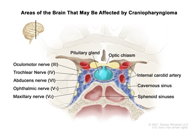 Drawing showing a coronal view of areas of the brain that may be affected by craniopharyngioma, including the pituitary gland and the optic chiasm. Also shown is the oculomotor nerve (III), trochlear nerve (IV), abducens nerve (VI), ophthalmic nerve (V1), maxillary nerve (V2), internal carotid artery, and the cavernous and sphenoid sinuses.