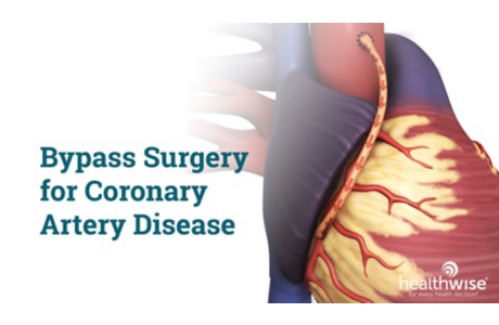 Bypass Surgery for Coronary Artery Disease