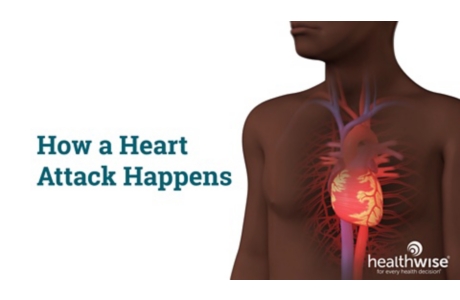 How a Heart Attack Happens