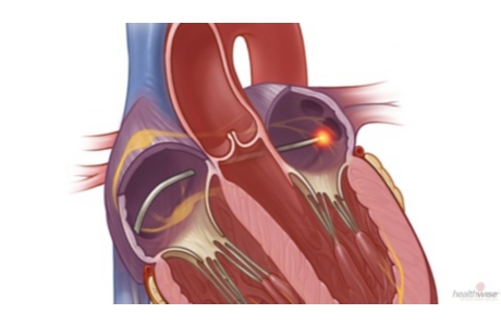 Catheter Ablation for Atrial Fibrillation: Before Your Procedure