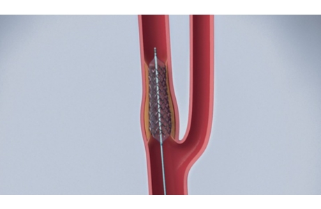 Carotid Artery Stenting: Before Your Procedure