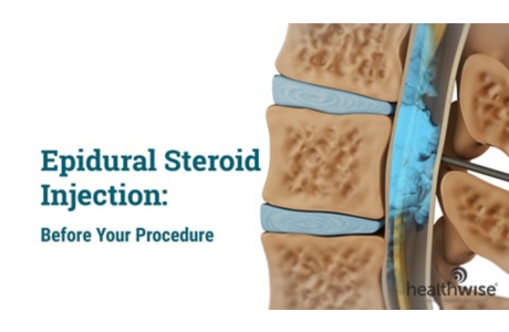 Epidural Steroid Injection: Before Your Procedure