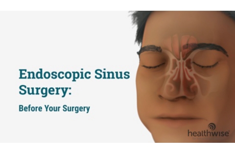Endoscopic Sinus Surgery: Before Your Surgery