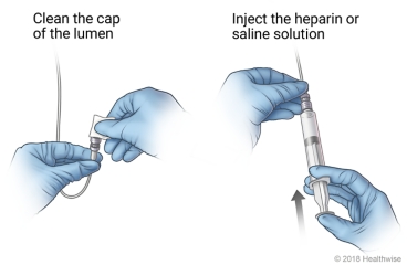 Cleaning the cap of the lumen and injecting the heparin or saline solution.