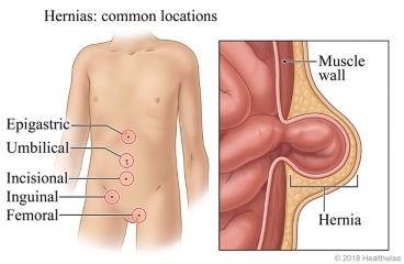 Locations of common types of hernias, with detail of a hernia protruding through the muscle wall